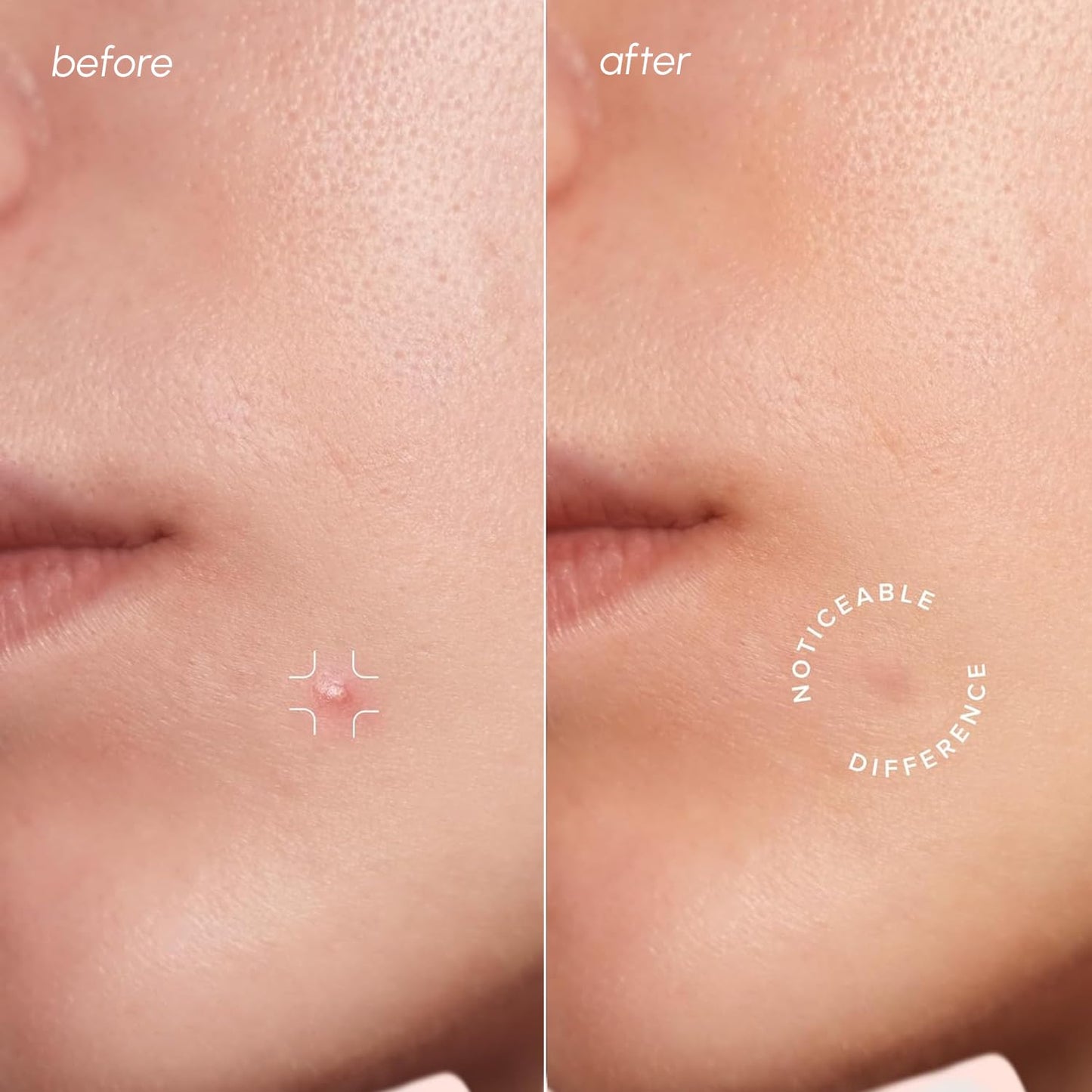 Invisible Pimple Patches